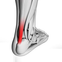 achilles tendonitis